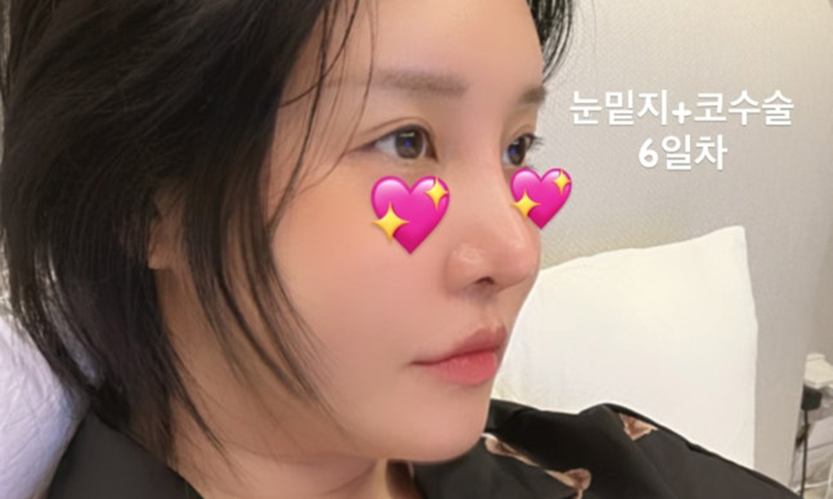 랄랄, 눈밑 지방 재배치+코수술 근황
